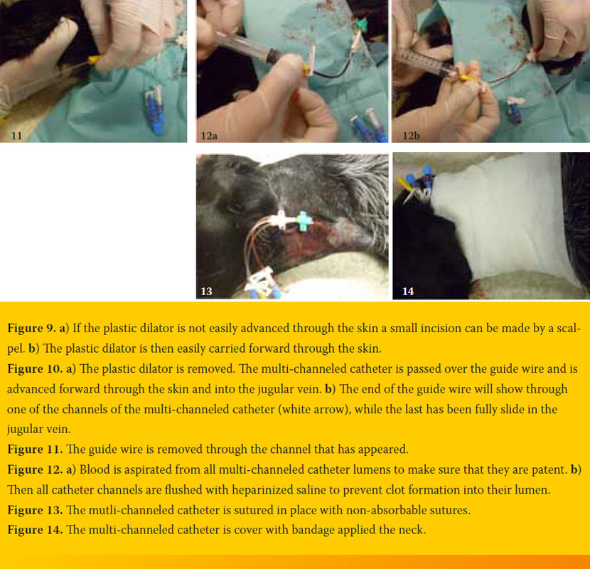 Jugular vein catheter placement Indications & technique