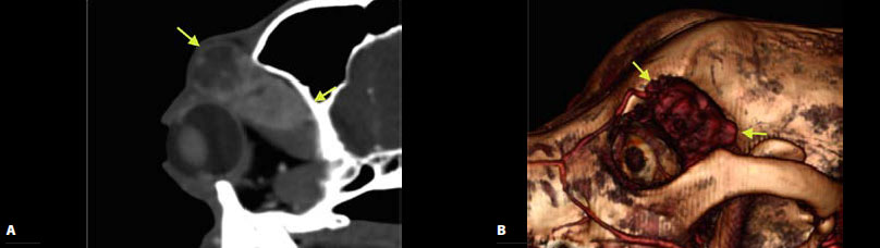 Neoplasia of lacrimal gland origin in a dog