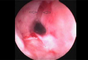 Oesophageal strictures associated with oral antibiotics in cats-a report of three cases