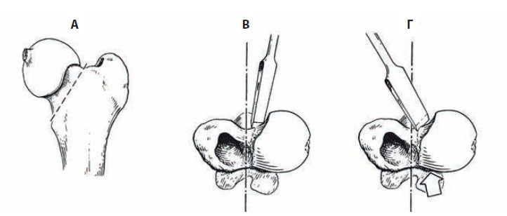 v8i2 femoral head excision img14