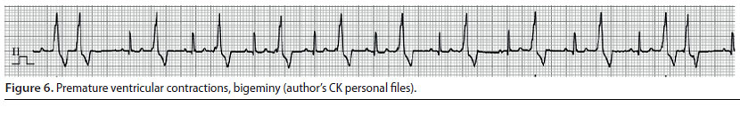 v8i2 perioperative cardiac arrhythmias img6 en